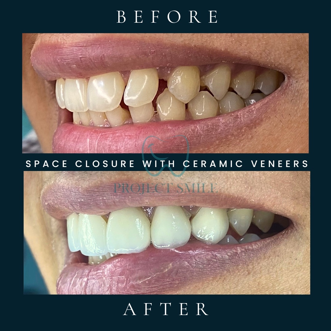 Smile Designing