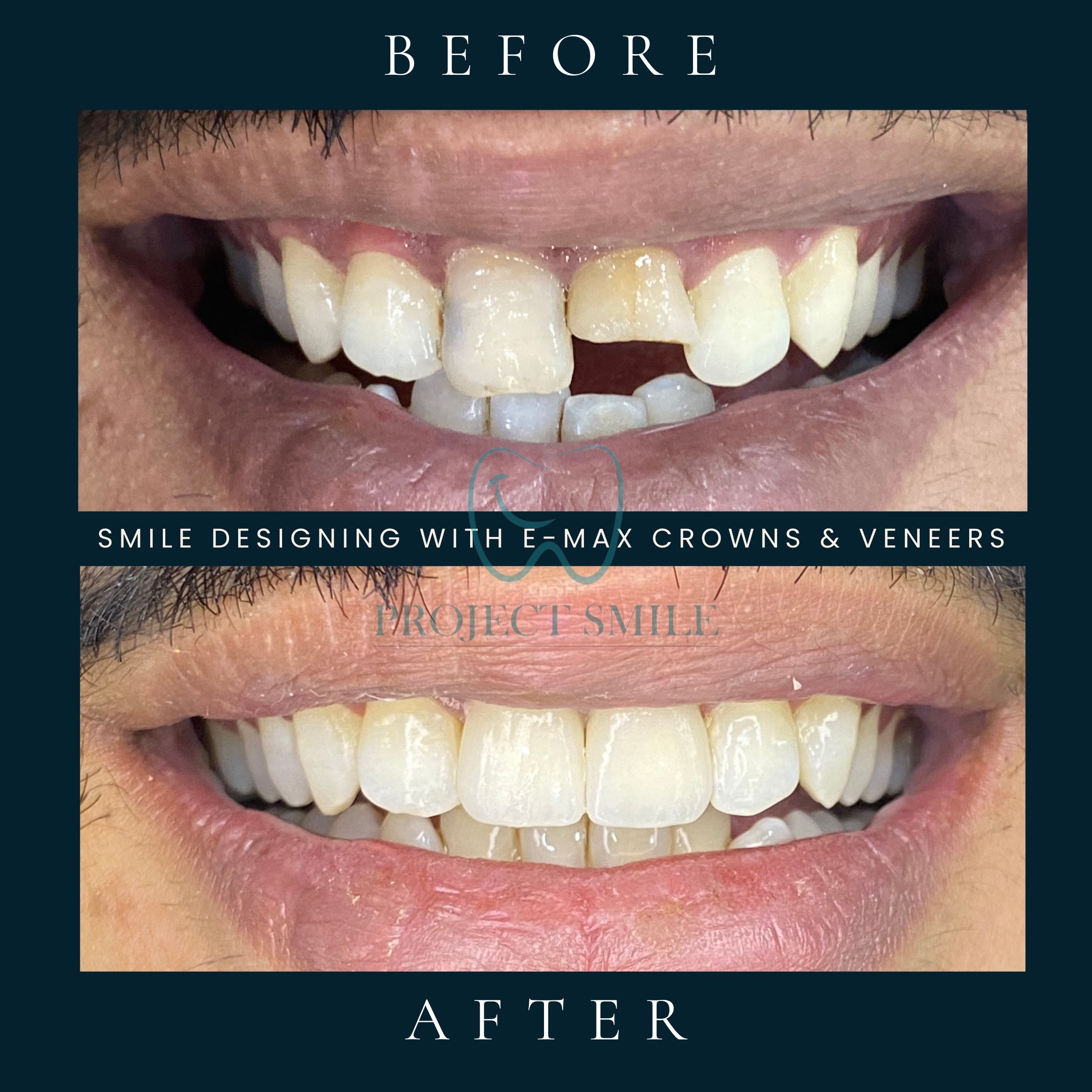 Smile Makeover