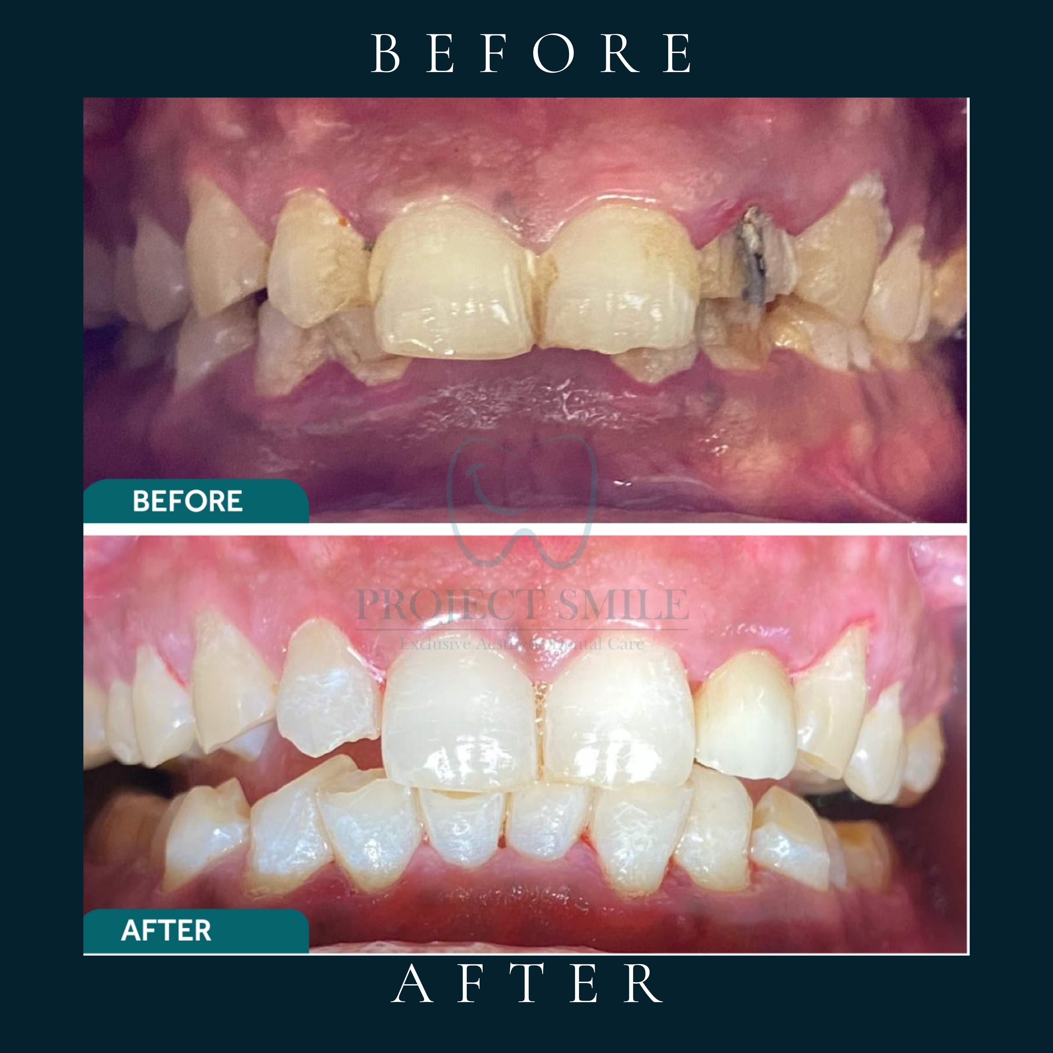 Full Mouth Rehabilitation