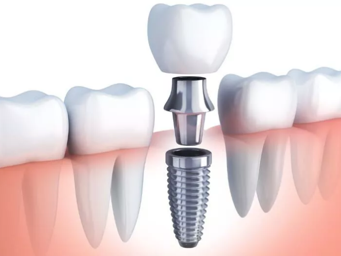 Dental Implants consultation at Project Smile in Indore
