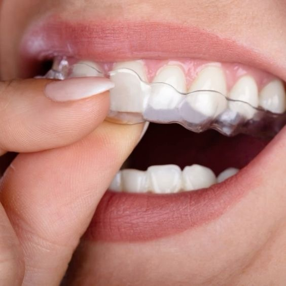 Invisalign & Clear Aligners