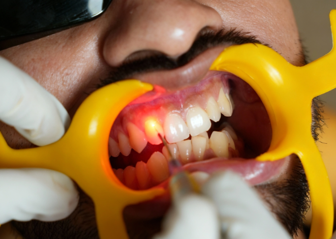 Laser Dentistry