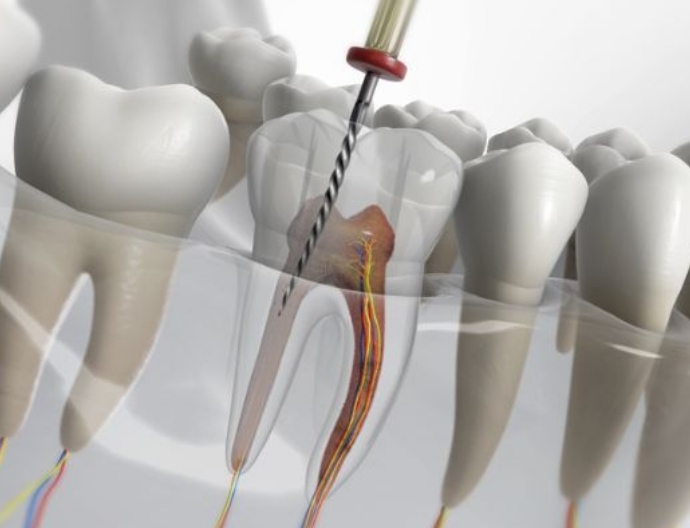 Painless Root Canal